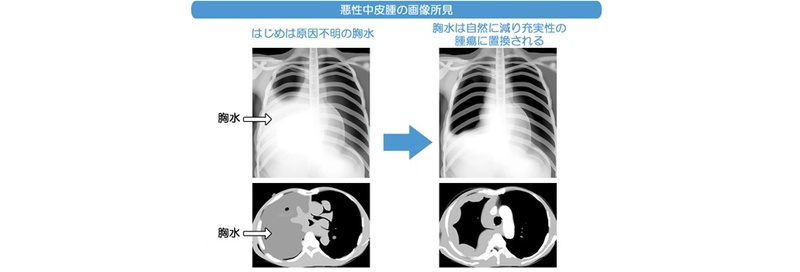 悪性中皮腫の画像所見