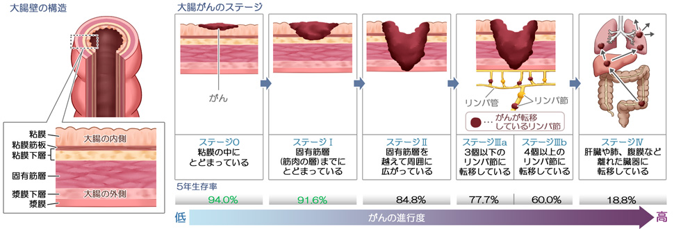 大腸がんのステージ