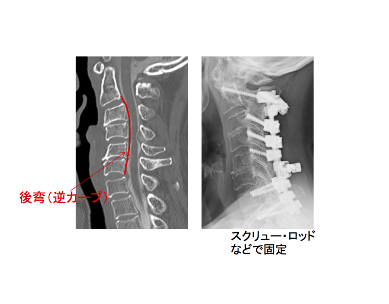 後方除圧固定術後