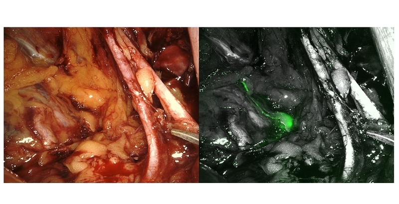 ICGと蛍光カメラを用いたダヴィンチによる骨盤内リンパ節郭清術（画像提供：山口雷藏先生）