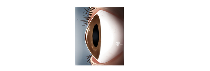 円錐角膜の特徴