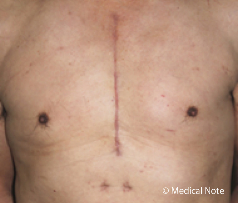 胸骨正中切開による手術創