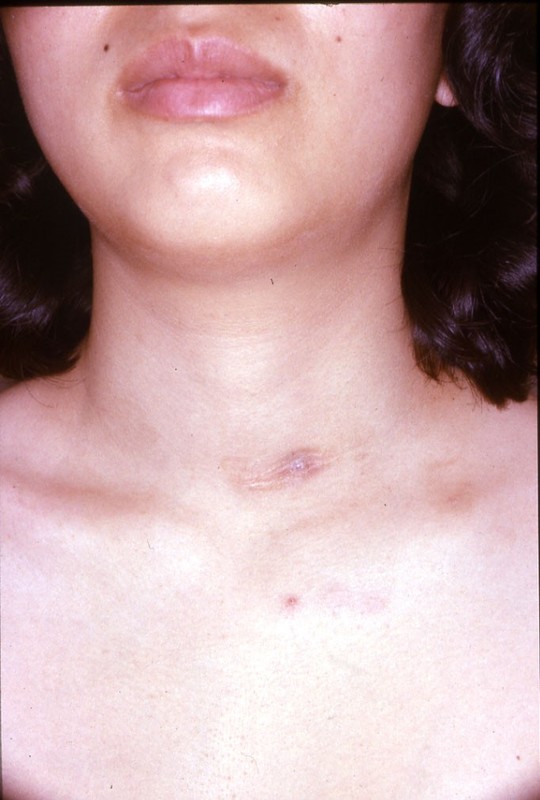 左前頸部に多数の切開瘢痕