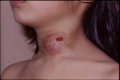 左前頸部に炎症があり、すでに排膿がみられる。　症例写真提供：宮内昭先生）
