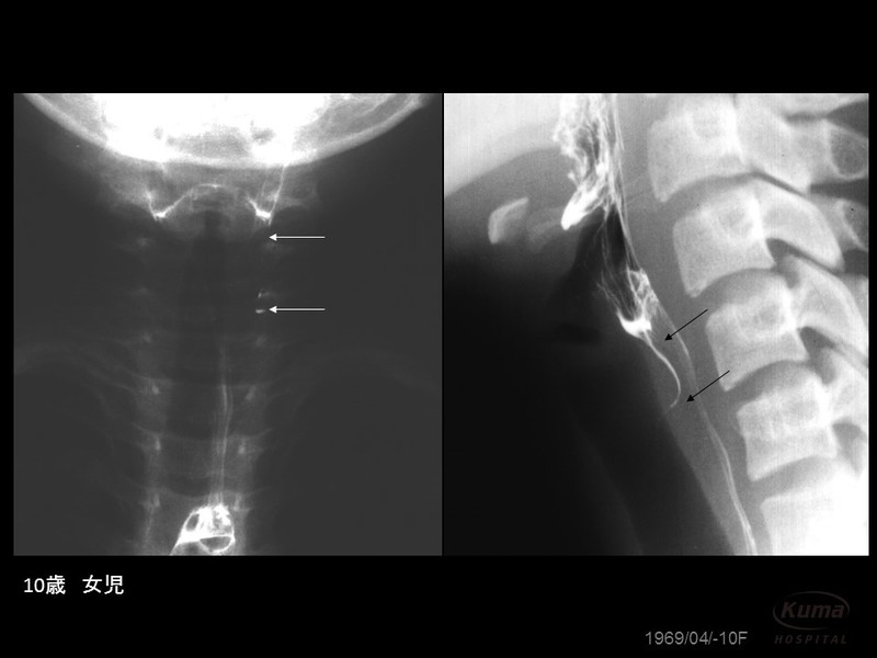 梨状窩から伸びる細い瘻孔　写真提供：宮内昭先生
