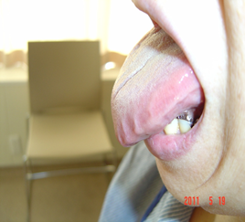 （ALアミロイドーシスの症状　舌の側面に歯型が残る　症例写真提供：鈴木憲史先生）