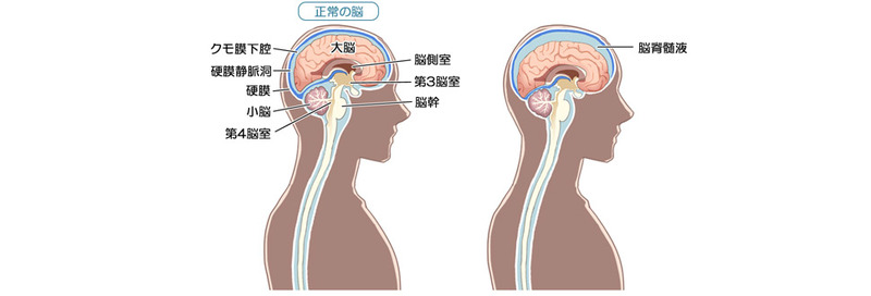 脳脊髄液減少症 医師が解説】脳脊髄液減少症と慢性上咽頭炎について【なかなか