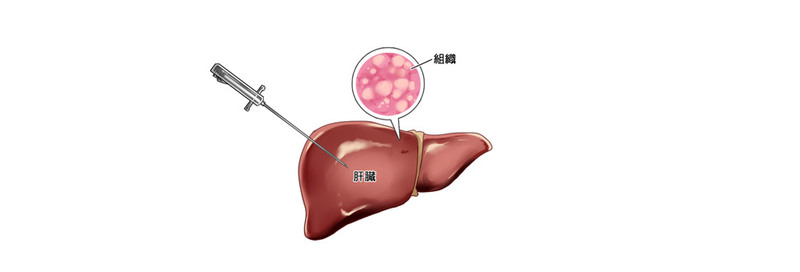 自覚症状がないnashを早期診断するために メディカルノート