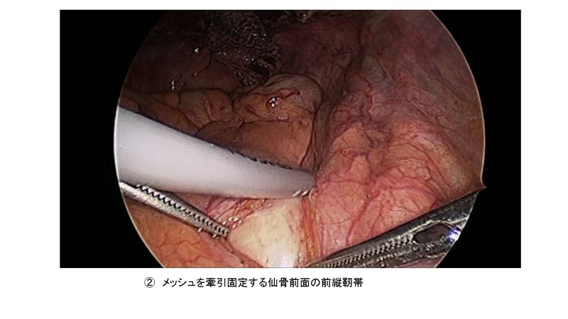 動画で見る 骨盤臓器脱の腹腔鏡手術?仙骨腟固定術を中心に 動画で見る 骨盤臓器脱の腹腔鏡手術−仙骨腟固定術を中心に | 明