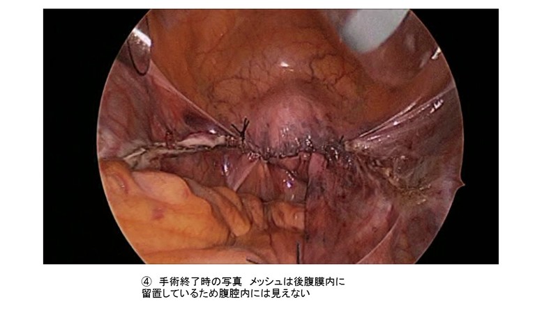手術の流れ④（石川哲也先生提供）