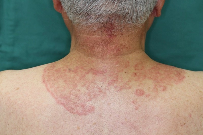 ペニスに白癬はありますか？