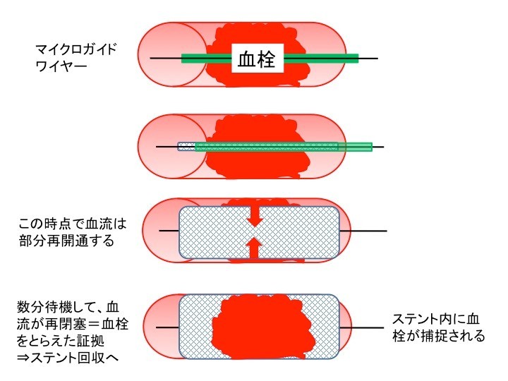 急性主幹動脈閉塞症の治療―血管内再開通治療について メディカルノート