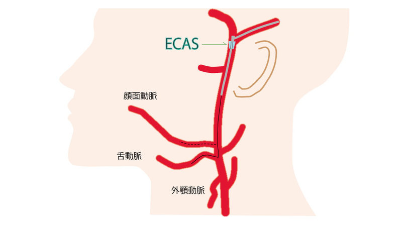 ECASを挿入留置して舌動脈や顔面動脈へ選択的に動注する