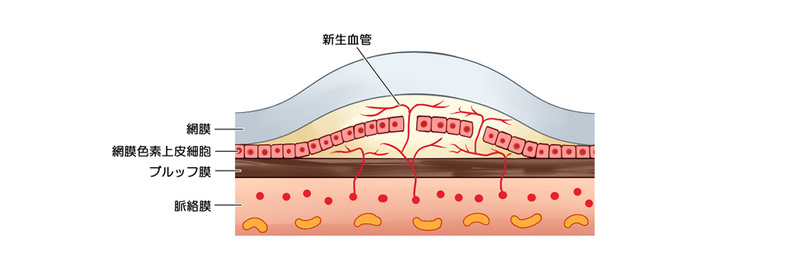新生血管（滲出型加齢黄斑変性）