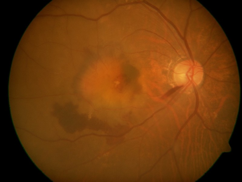 黄斑直下に新生血管塊が形成／周囲に出血と網膜（黄斑）の浮腫