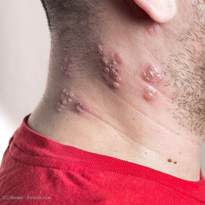 画像：首の右側後ろにできた帯状疱疹（水ぶくれ）の症状写真