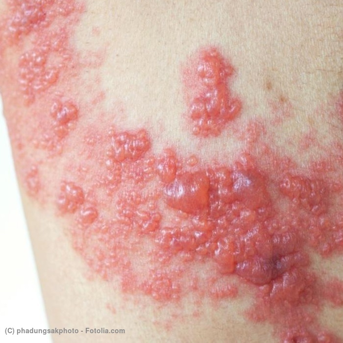 典型的な帯状疱疹の症状写真