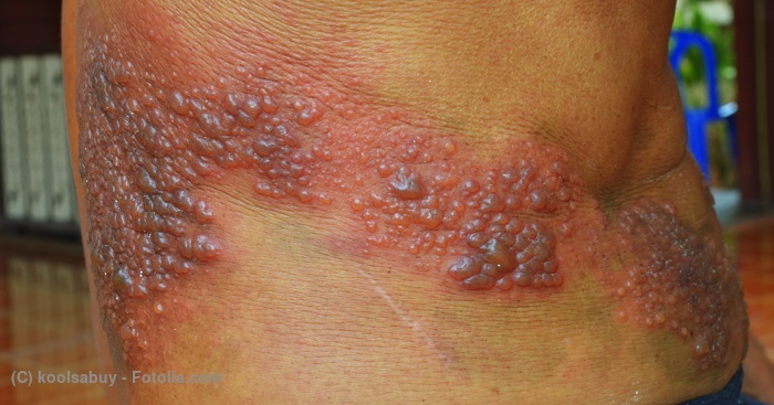 医師監修 作成 つづらごは帯状疱疹 たいじょうほうしん の別名 原因はウイルス Medley メドレー