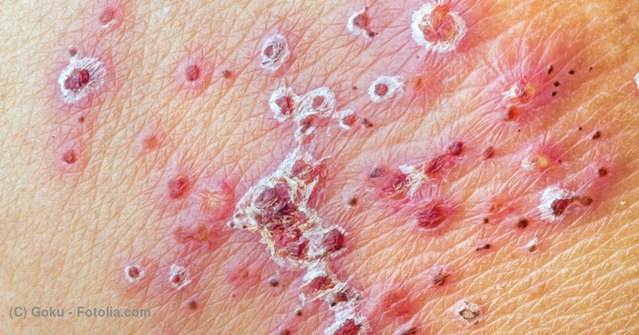 画像：つづらご（帯状疱疹）がかさぶたになった写真。かさぶたは数週間で消えるが、その後も帯状疱疹後神経痛という後遺症を残す場合がある。