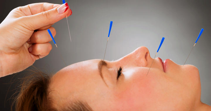 くしゃみとかゆみが軽くなった！アレルギー性鼻炎の鍼治療の写真