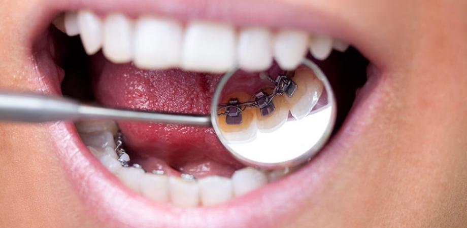Affordable Dental Implants In Washington Dr C Family Dentistry Peatix