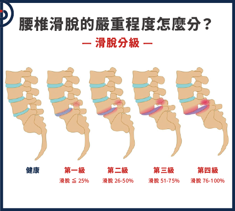 滑脫分級