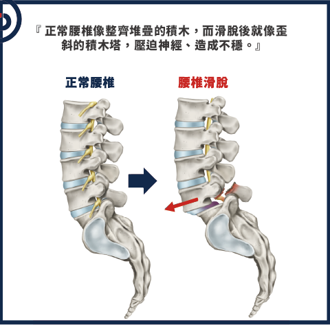 腰椎滑脫