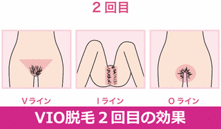VIOの画像