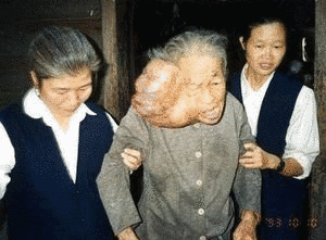 人面瘡の画像