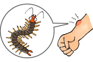 ムカデに刺された腕のイラスト
