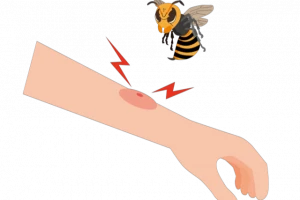 腕をハチが刺している絵