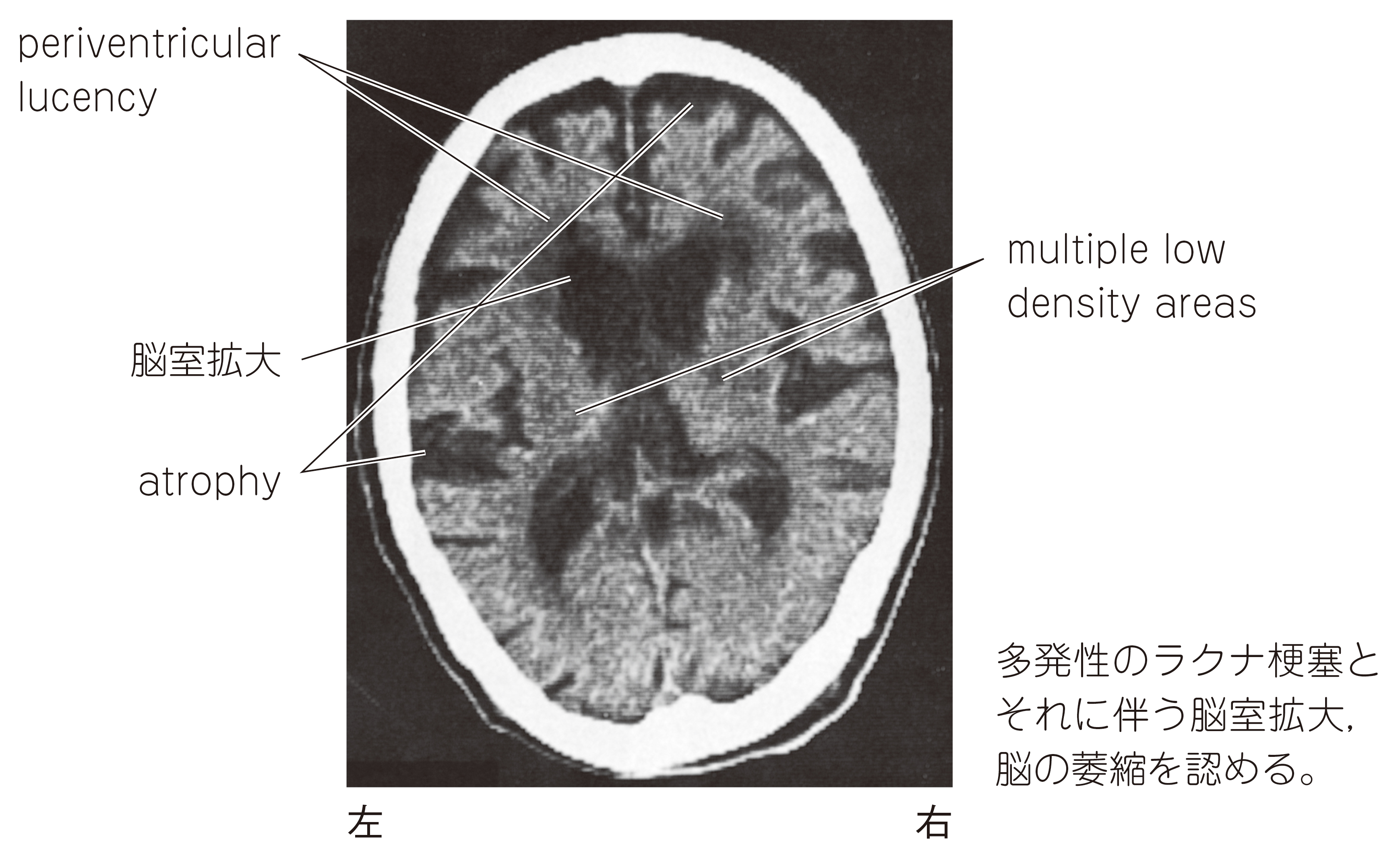 81D28 | 脳血管性認知症 国試 | M3E Medical 81D28 | 脳血管性認知症 国試 | M3E Medical