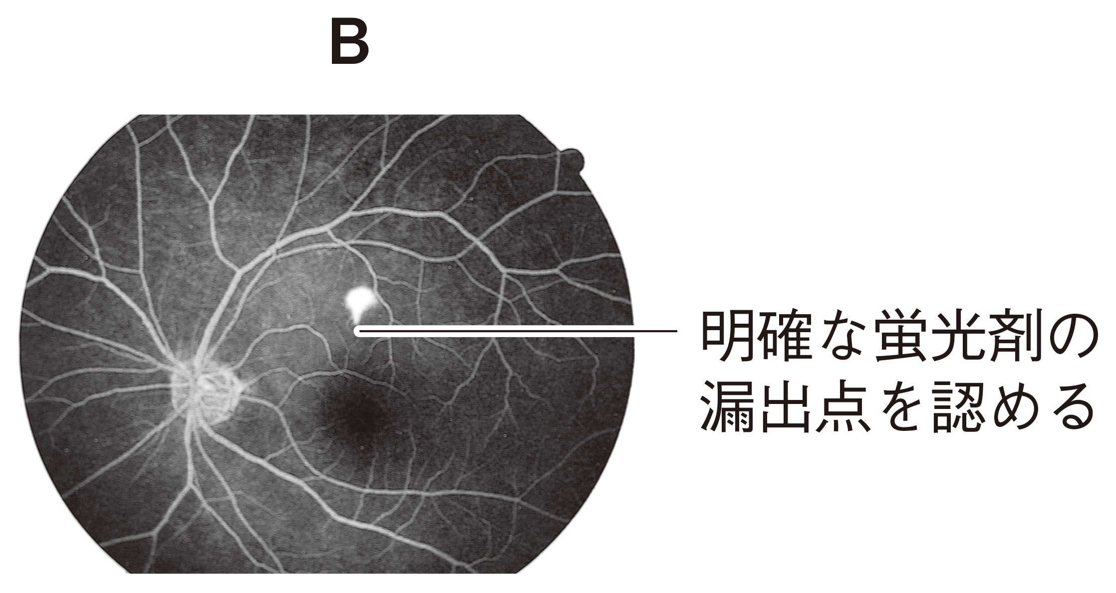 88D21 | 中心性漿液性脈絡網膜症 国試 | テコプラ