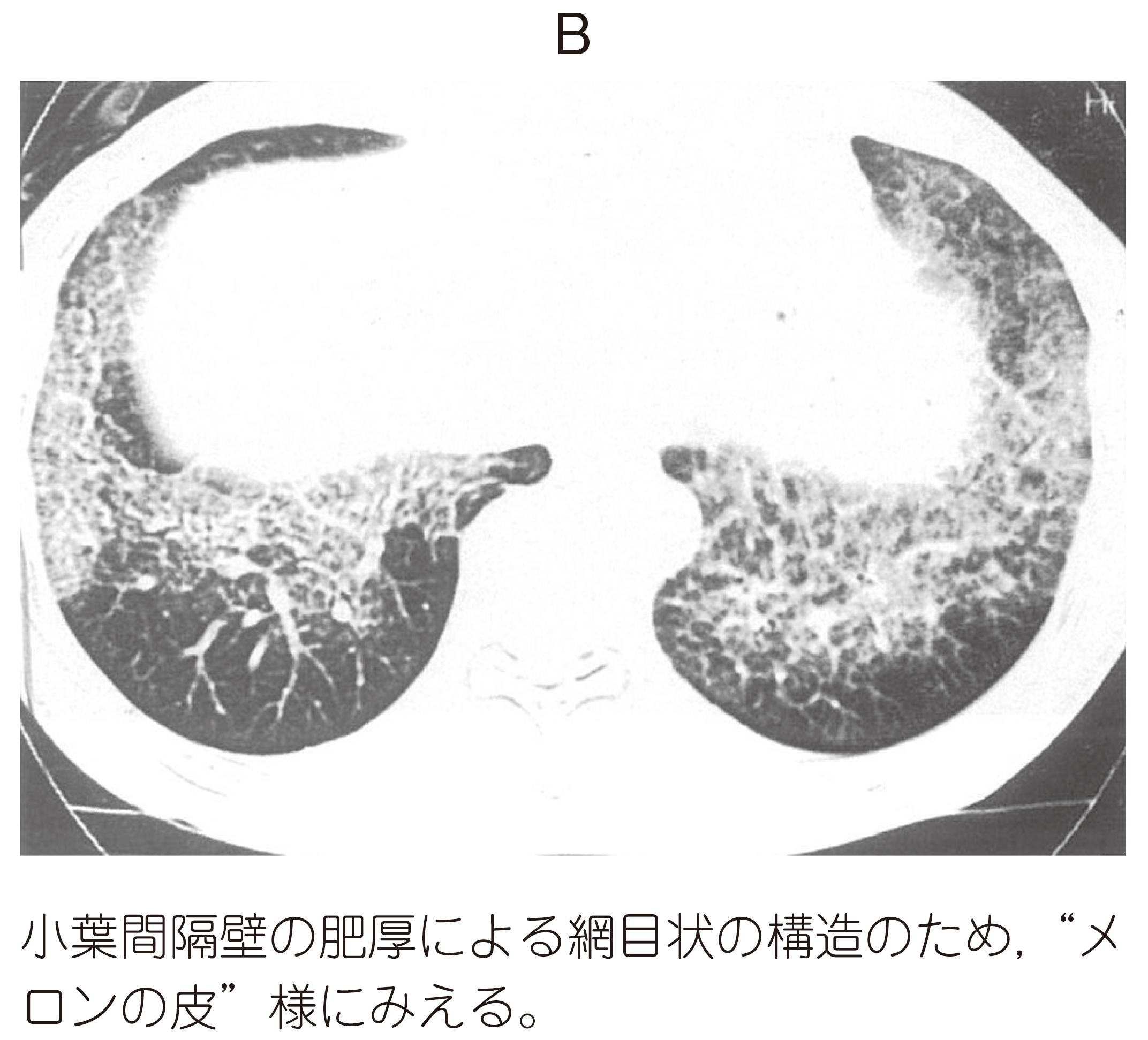 肺部感染 肺泡蛋白沉积症？讨论病例【中美加非妇科细胞学交流群病例175】 - 中美加非妇科细胞学交流群 - 91360病理论坛