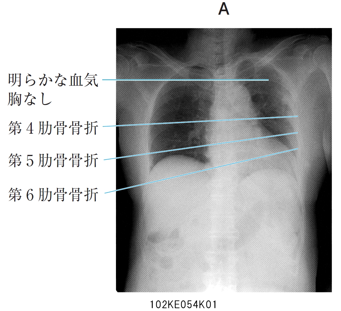 102E54 | 循環血液量減少性ショック 国試 | M3E Medical