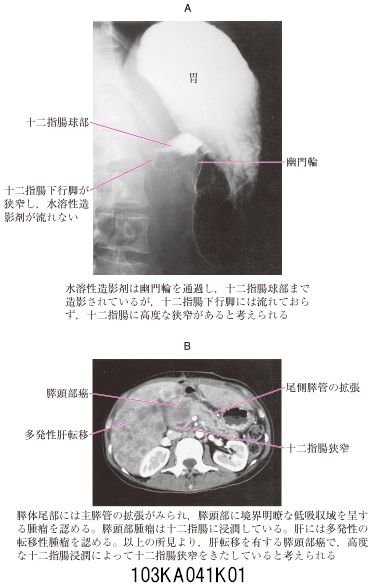 103A41 | 膵癌 国試 | M3E Medical