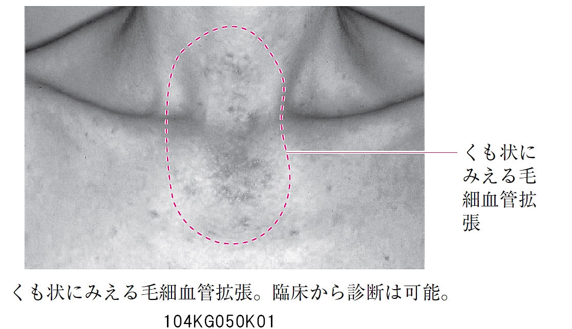 110D29 | 縦隔腫瘍 国試 | テコプラ
