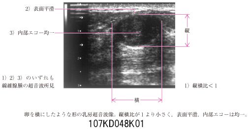 107D48 | 乳腺線維腺腫 国試 | テコプラ 107D48 | 乳腺線維腺腫 国試 | テコプラ