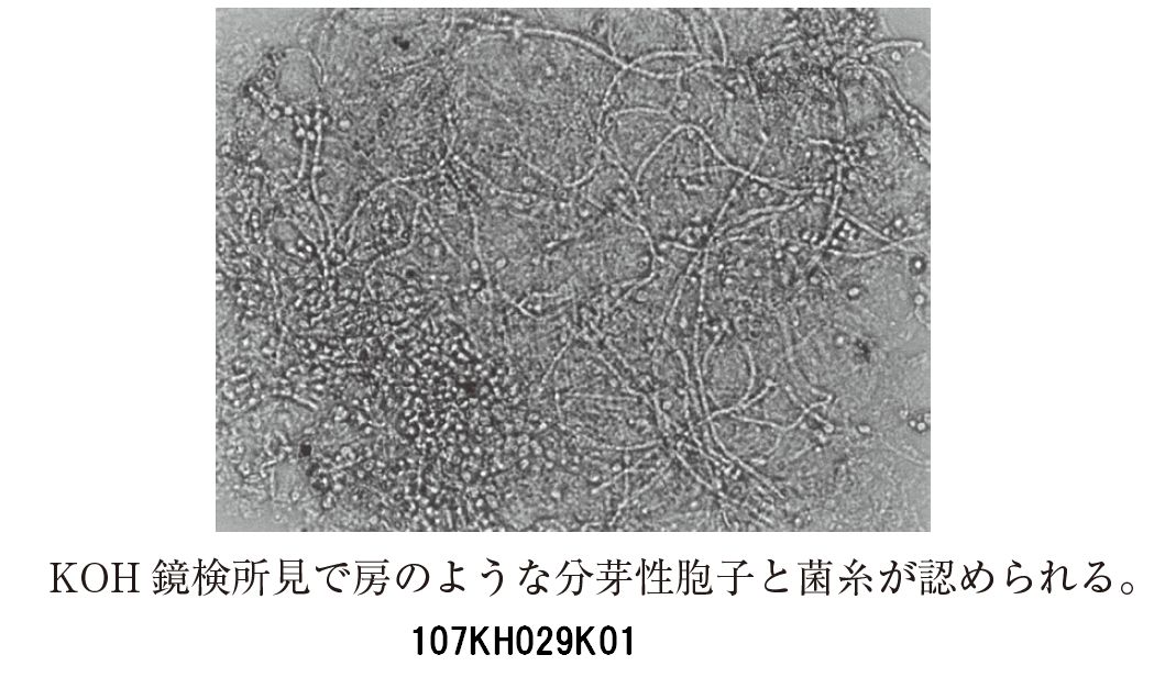 107H29 | カンジダ症 国試 | テコプラ