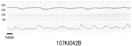 107I42 | 常位胎盤早期剝離 国試 | M3E Medical