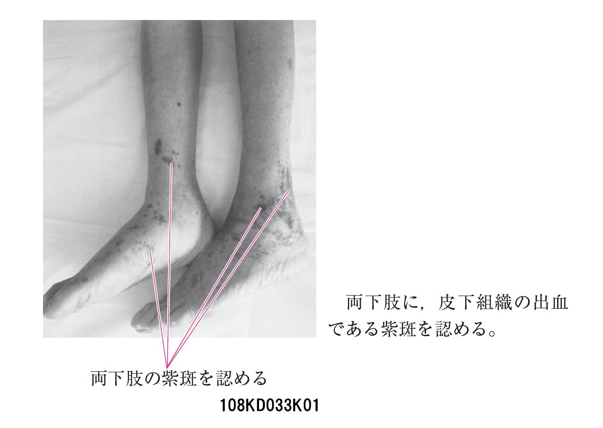 225.SLE手掌部血管炎-内分泌-医学