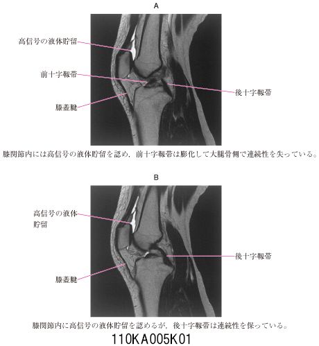110A5 | 膝靭帯損傷 国試 | テコプラ