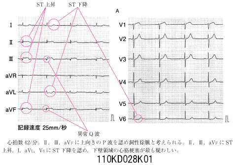 110D28 | 房室ブロック 国試 | M3E Medical