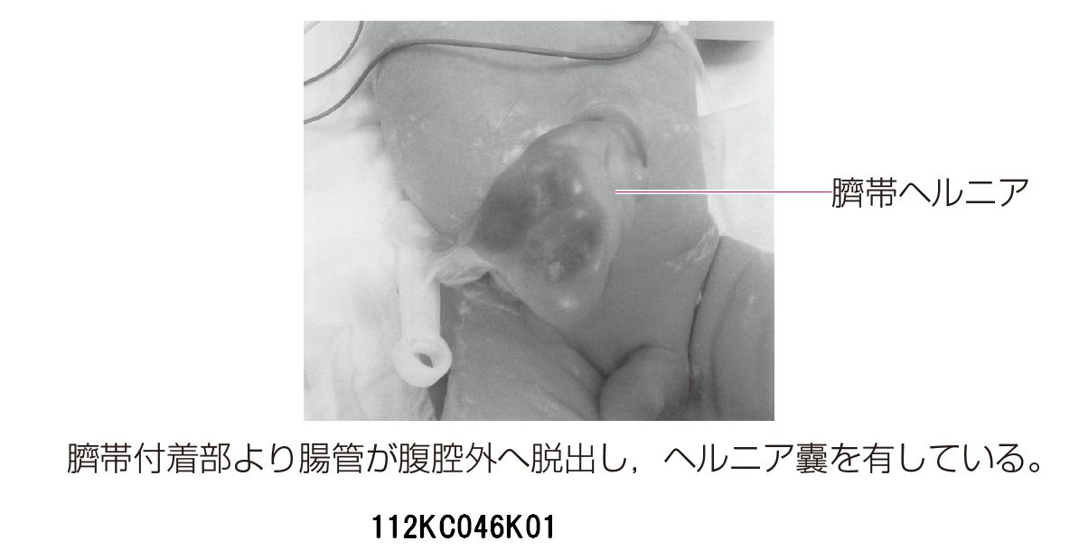 先天異常 112C46 | 臍ヘルニア・臍帯ヘルニア, 染色体異常症 国試 | テコプラ