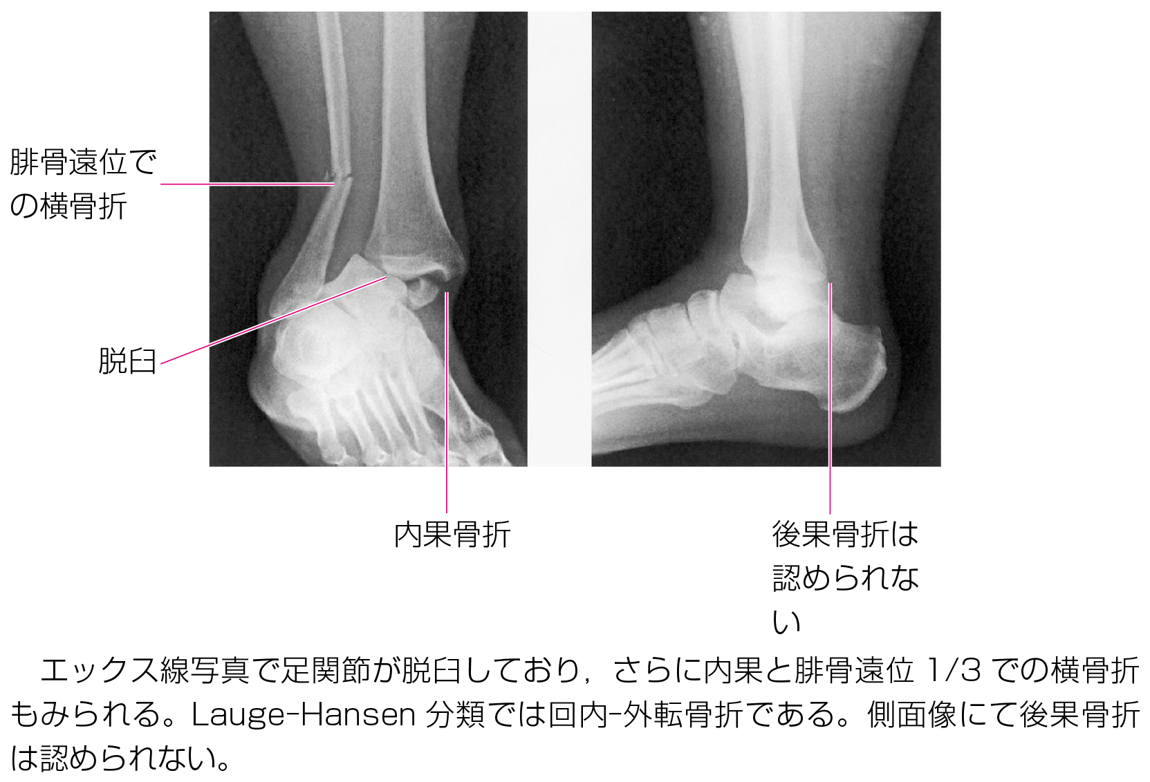 113B36 | 骨折 国試 | M3E Medical