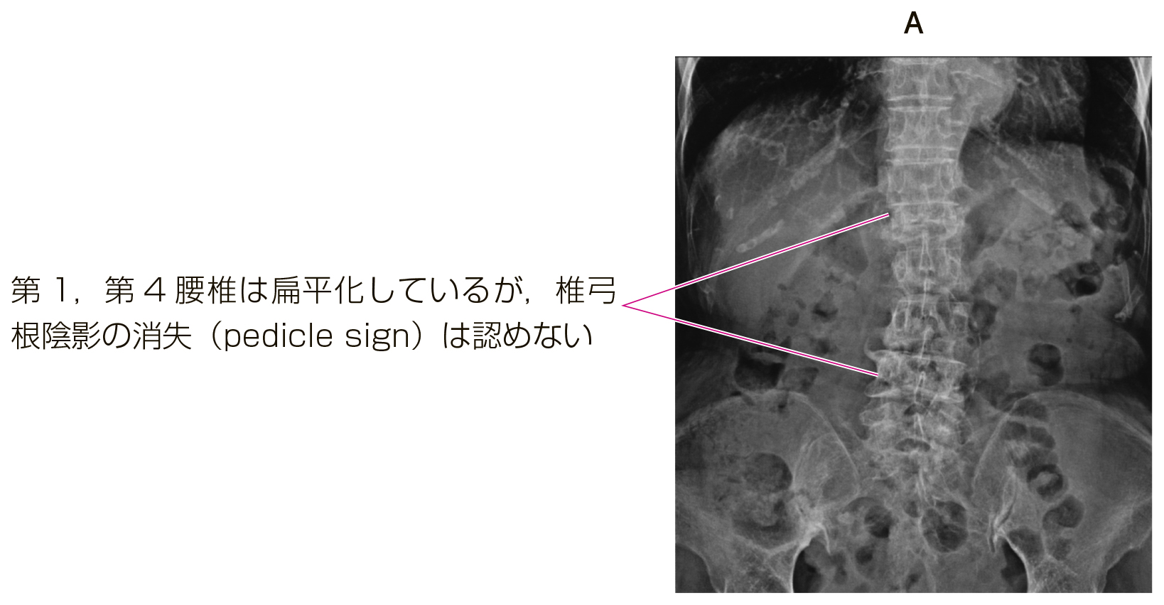 115D37 | 脊椎圧迫骨折 国試 | M3E Medical