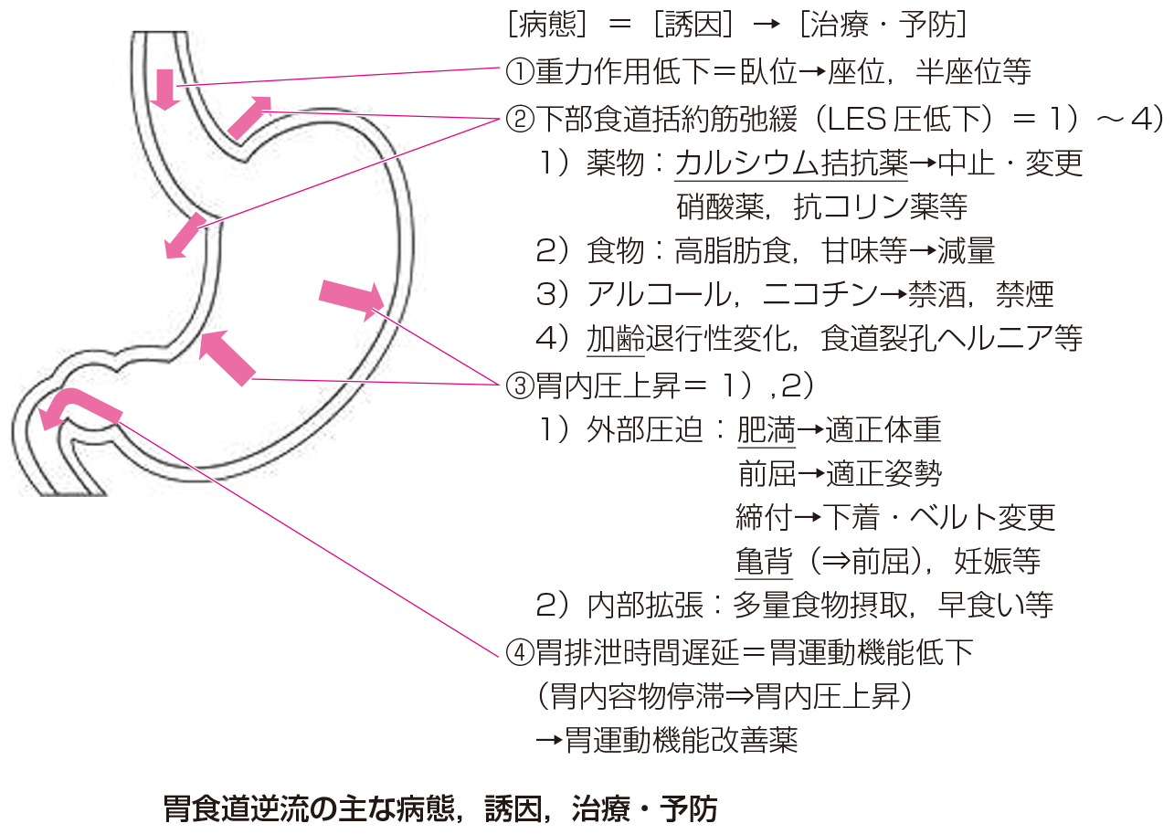 胃食道逆流症の進行段階について知っておくべきこと - RxCare