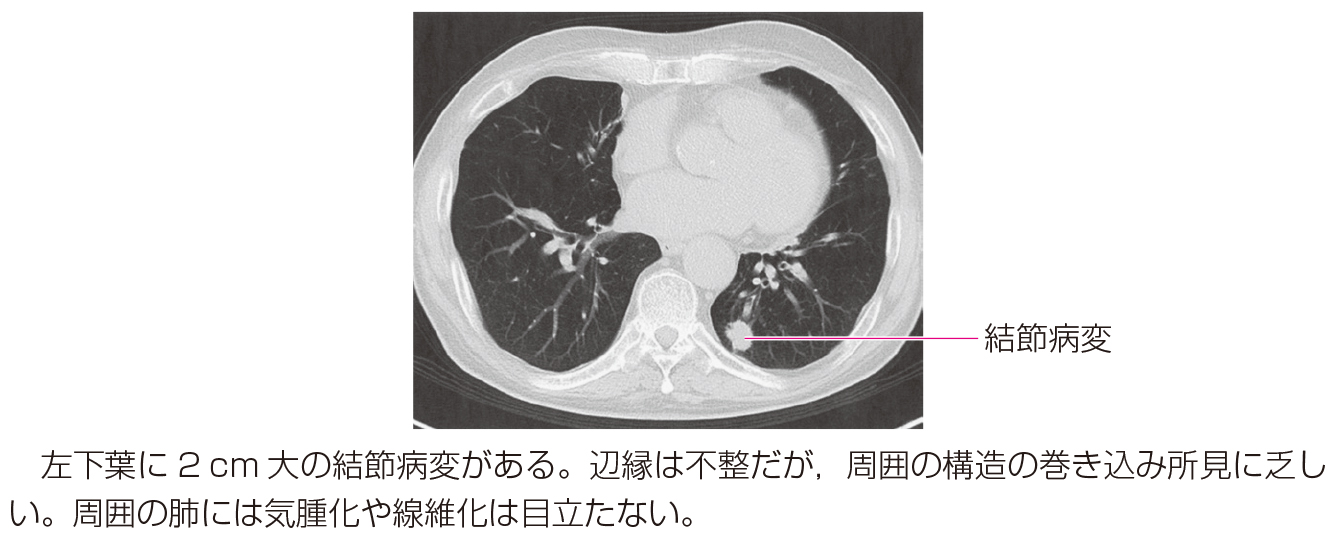 116A66 | 縦隔腫瘍 国試 | テコプラ