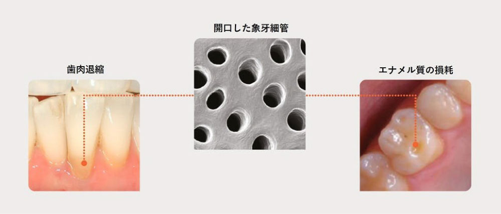 ご存知でしたか？3人に1人が悩んでいる象牙質知覚過敏のこと