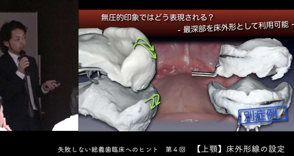 失敗しない総義歯臨床へのヒント 第4回『上顎床外形線の設定』の画像です